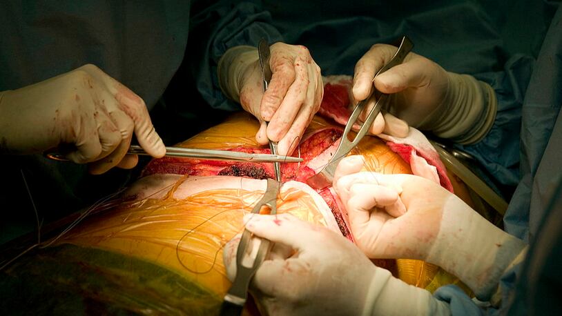 Surgeons stitching surgical wound during a liver transplant operation