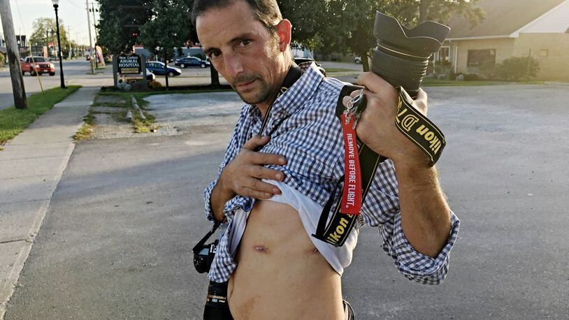 New Carlisle News photographer Andy Grimm on Friday, Oct. 20, 2017, shows where a bullet went in through his torso and out the side while on the scene of an accident. He was shot around 2 a.m. Sept. 4 when a Clark County Sheriff's deputy said he mistook Grimm's camera for a gun.