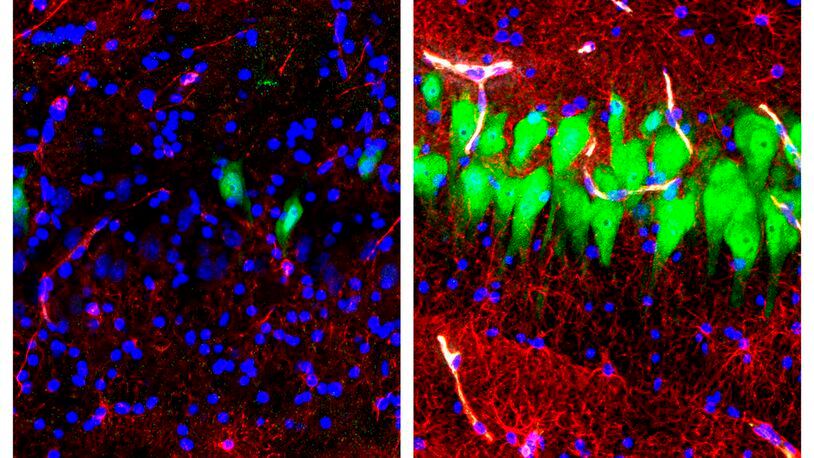 This combination of images provided by the Yale School of Medicine in April 2019 shows stained microscope photos of neurons, green; astrocytes, red, and cell nuclei, blue, from a pig brain left untreated for 10 hours after death, left, and another with a specially designed blood substitute pumped through it. By medical standards âthis is not a living brain,â said Nenad Sestan of the Yale School of Medicine, one of the researchers reporting the results Wednesday, April 17, 2019, in the journal Nature. But the work revealed a surprising degree of resilience within a brain that has lost its supply of blood and oxygen, he said.