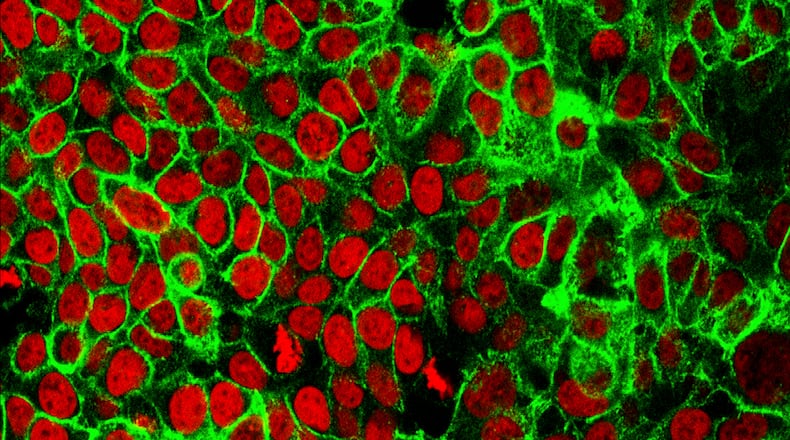 FILE - This microscope image made available by the National Cancer Institute Center for Cancer Research in 2015 shows human colon cancer cells with the nuclei stained red. Americans should start getting screened for colon cancer earlier, at age 45 instead of waiting until they're 50, according to guidelines from the U.S. Preventive Services Task Force. (NCI Center for Cancer Research via AP, File)