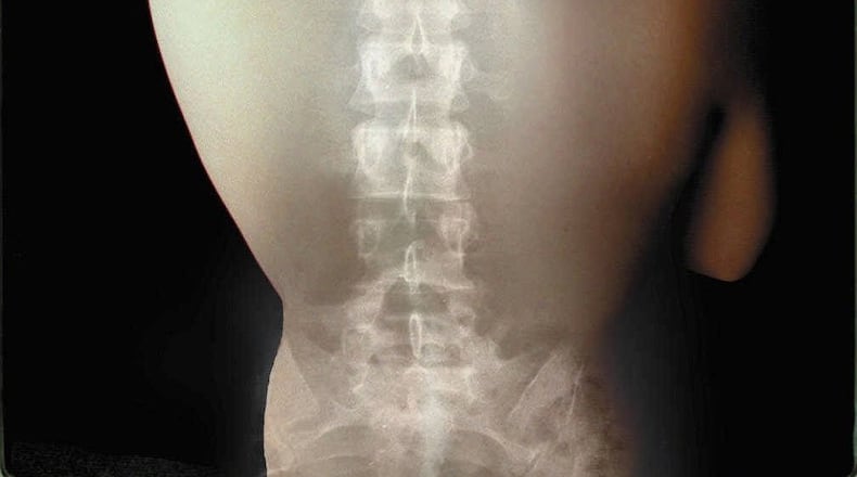 The X-ray of a spine super-imposed on a woman’s back illustrates the importance of monitoring and treatment of osteoporosis, a weakening of the bones that affects 25 million Americans. FILE