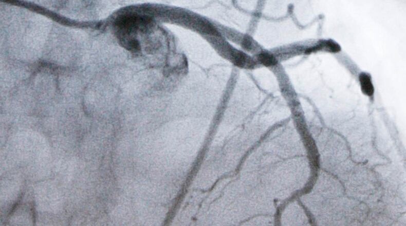 FILE - A monitor shows an artery during a catheterization lab heart procedure in Burlington, Vt., Tuesday, Sept. 23, 2008. (AP Photo/Toby Talbot, File)