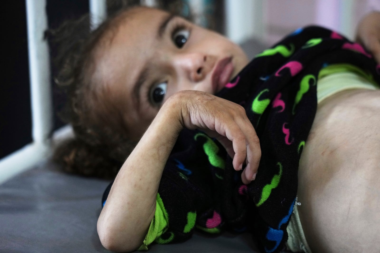Palestinian girl Mayar Al-Arja, 2, who suffers from malnutrition, lays on a bed at the malnutrition clinic in Nasser hospital, Khan Younis, Gaza, Wednesday, May 21, 2025. (AP Photo/Abdel Kareem Hana)