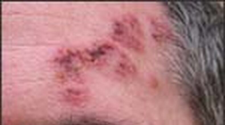 Shingles is a painful rash. Centers for Disease Control and Prevention