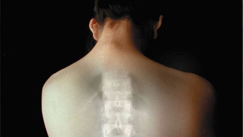 The X-ray of a spine super-imposed on a woman’s back illustrates the importance of monitoring and treatment of osteoporosis, a weakening of the bones that affects 25 million Americans. FILE
